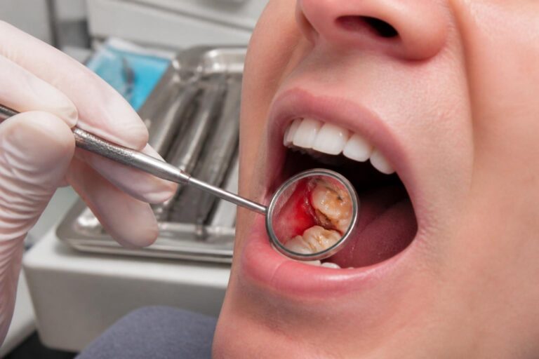 découvrez comment reconnaître les symptômes d'une infection dentaire, les premiers gestes à adopter pour soulager la douleur et les options de traitement efficaces pour protéger votre santé bucco-dentaire.